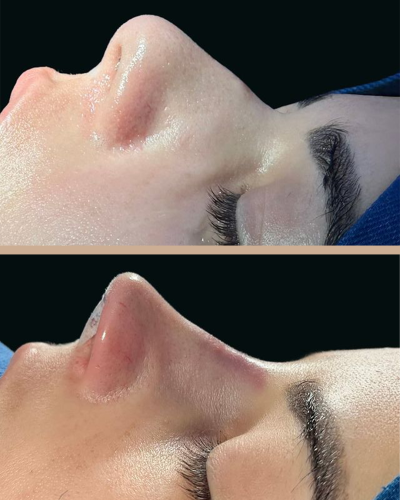 Dr. Marcelo Lins -Rinoplastia Ultrassônica Lifting Facial Crânio Facial Recife