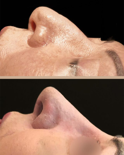 Dr. Marcelo Lins -Rinoplastia Ultrassônica Lifting Facial Crânio Facial Recife