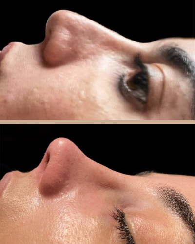 Dr. Marcelo Lins -Rinoplastia Ultrassônica Lifting Facial Crânio Facial Recife