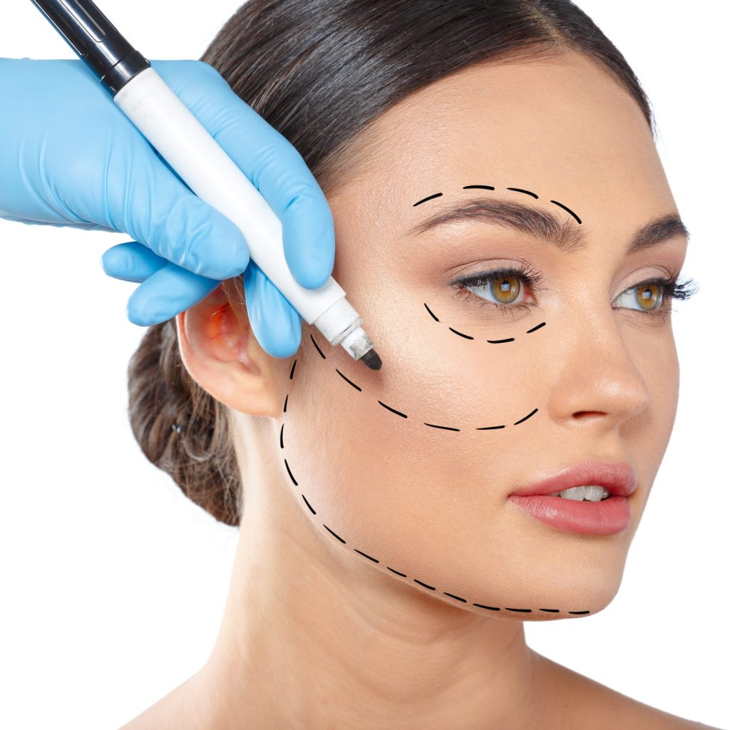 woman with dotted lines on face, cosmetology - Rinoplastia Ultrassônica Lifting Facial Crânio Facial Recife 3